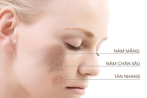 Những vùng trên da mặt thường xuất hiện nám 