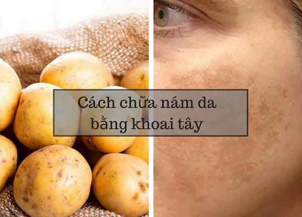 Trị nám bằng khoai tây và nước cốt chanh bạn đã làm chưa?